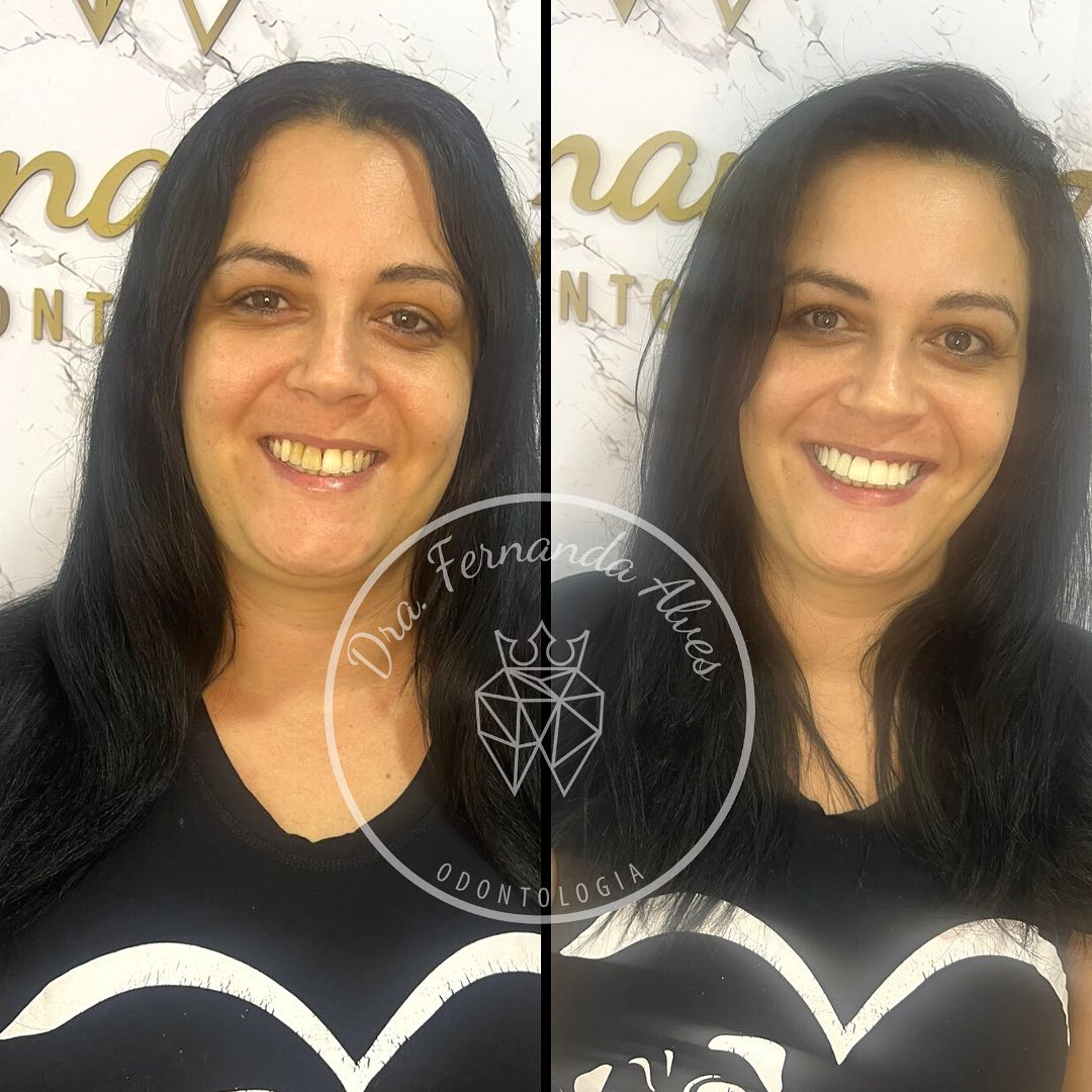 Fechamento de Diastemas (antes e depois)